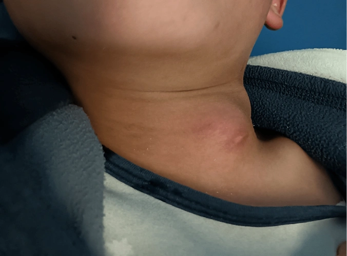 徐州市儿童医院专家提醒:儿童颈部反复感染?