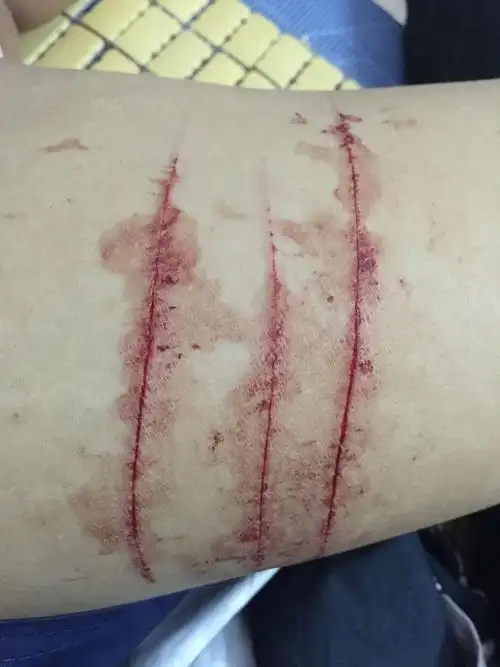 哎 又是吵架,用碗划破大腿 怎么治疗