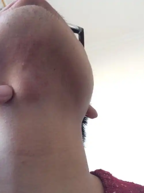 喉结上方喉咙那块长了个包怎么回事,有点硬,用手按有一点疼