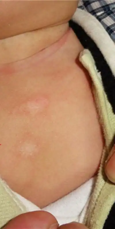 北京花斑癣医院_北京治疗花斑癣哪家医院好_北京治疗花斑癣权威的医院