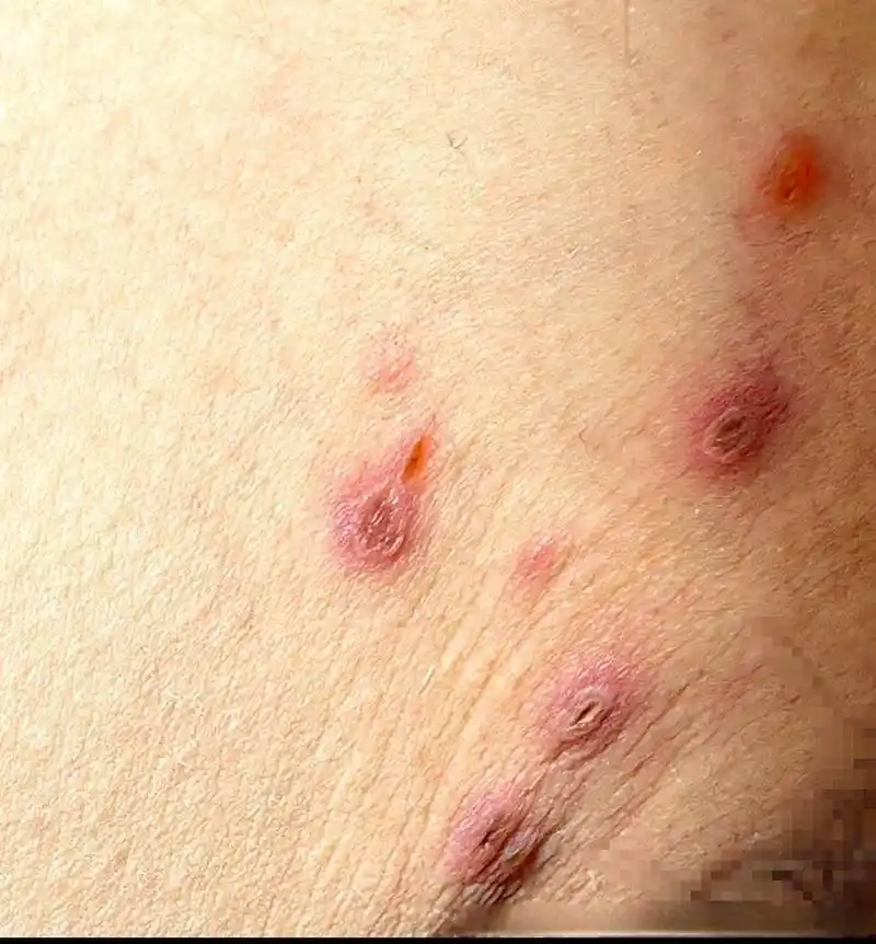 医生你好,在腹股沟的位置起了几个这样的疹子,快一