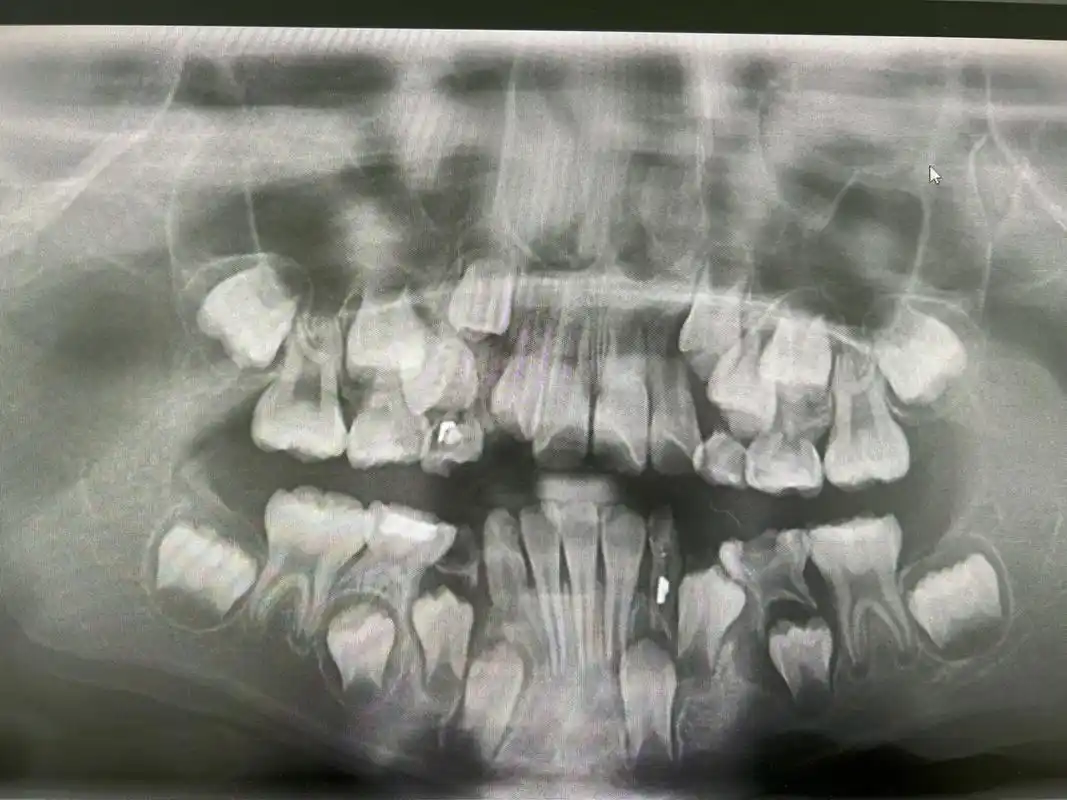 快来看看小孩子换牙期的牙片#牙片分析 #满脸都是牙 - 抖音