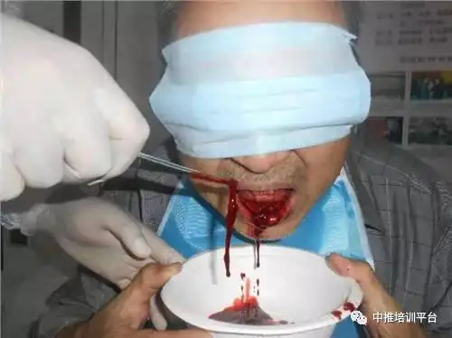 舌下取血栓原理 舌系带两旁静脉放血:因舌下神经的血供非常丰富,舌