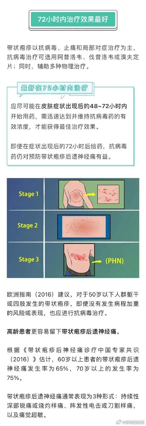 蔡国庆患急性带状疱疹#【带状疱疹72小时内治疗效果好】带状疱