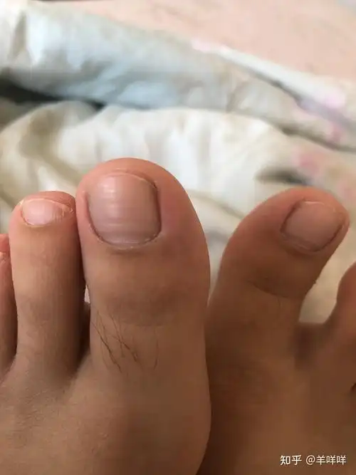 甲分离型灰指甲治愈过程