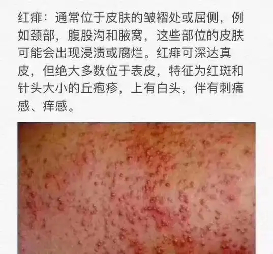 皮炎最佳治疗方法胞疹痱子症状图片热疹症状图片热痱子的症状图片脖子