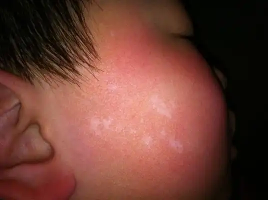 北京白色糠疹医院_北京治疗白色糠疹哪家医院好_北京治疗白色糠疹最好