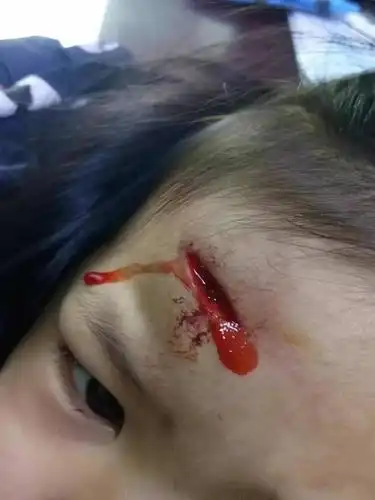 利川4岁小孩在幼儿园被摔伤,孩子还有安全之地么?_手机搜狐网