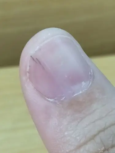 指甲里有黑线,像是血丝,按压会痛,有时有,有时没有,反反复复好多年了
