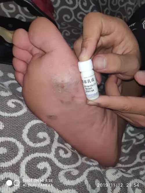 斑蝥素治疗跖疣