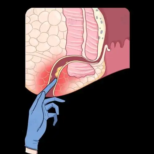 裤子脱了腿张开医院让人脸红的肛门指检竟能查出这么多病