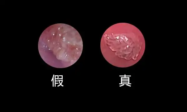 女性外阴长痘痘是怎么回事