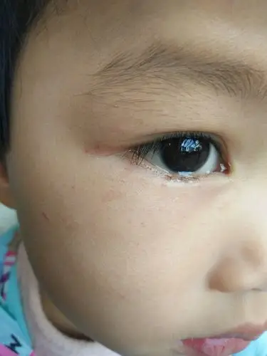 宝宝三岁,发烧后脸上局部红点,宝宝不痛不痒,以前有出过疹子的.