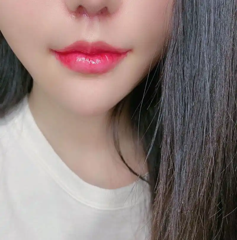 玻尿酸丰唇能维持多久?做唇部整形需要注意些什么?