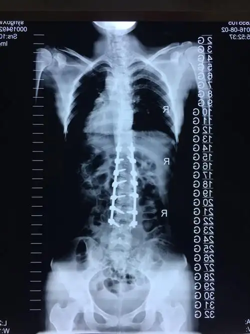 青少年特发性脊柱侧弯之二 - 好大夫在线