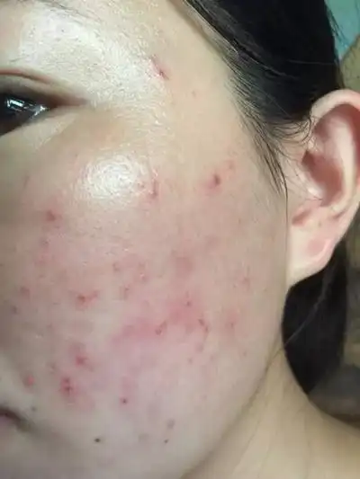 脸上螨虫图片 (36)_有来医生