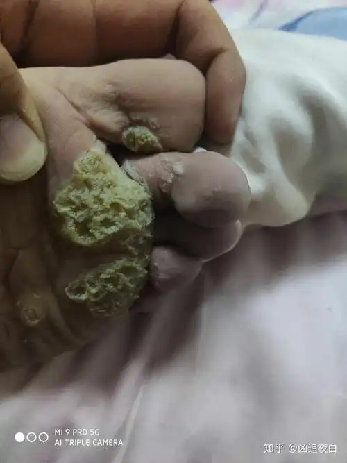 患过趾疣的进,大家说说自己的书怎么治好的 ? - 知乎