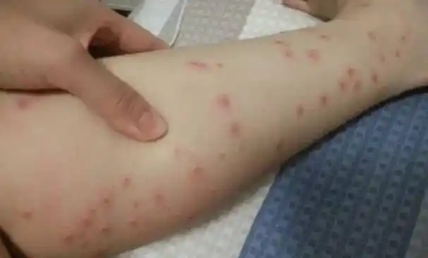 蜱虫狗图片,医生:奶奶做得好(蜱虫图片)