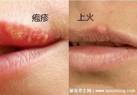 疱疹和上火水泡的区别图,病毒感染的疱疹灼热疼痛会传染