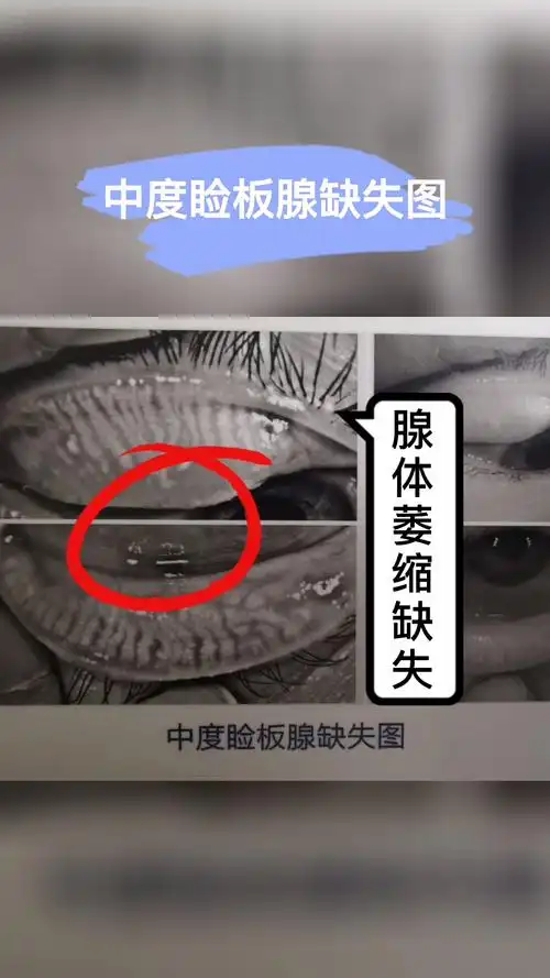 你知道正常的睑板腺长什么样吗