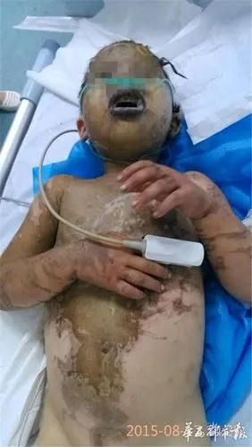 (郴州两兄妹遭灌硫酸,五岁女童死亡.