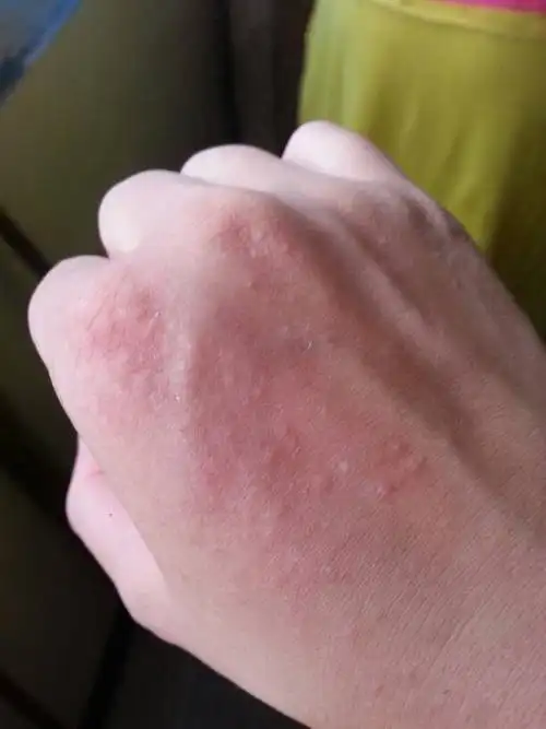 手上很痒,不痒的时候就是和皮肤颜色一样,痒起来特别痒!