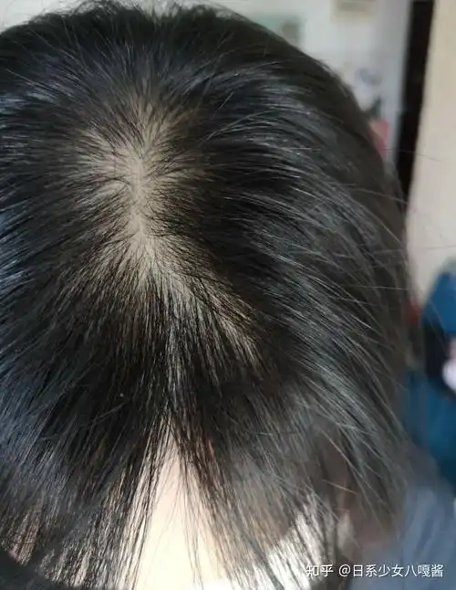 头发超级油还掉头发用什么洗发水比较好