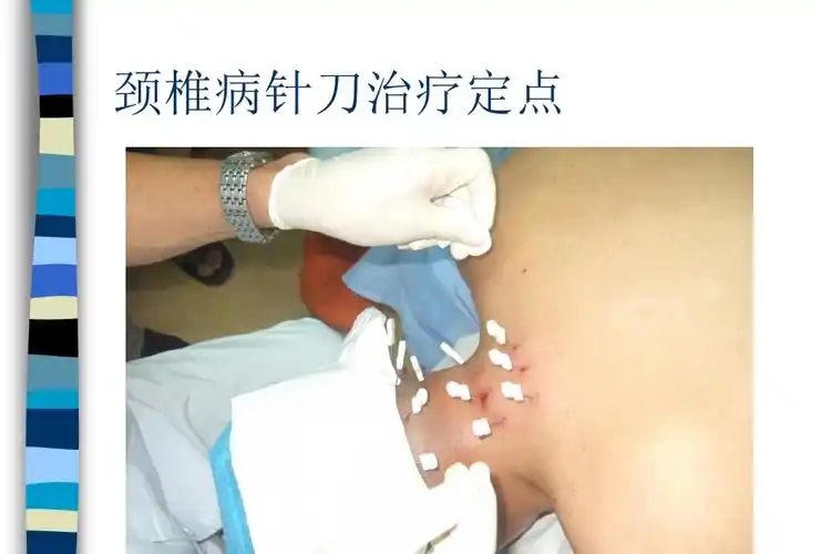 针刀治疗颈椎病