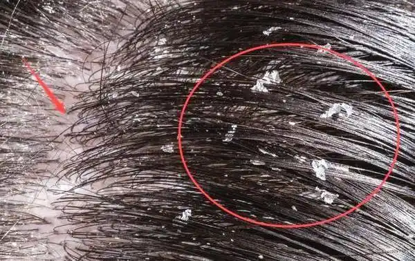 有害菌大量滋生,就会出现头痒的现象而头皮角质层代谢