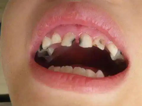 牙齿是怎么被虫吃的