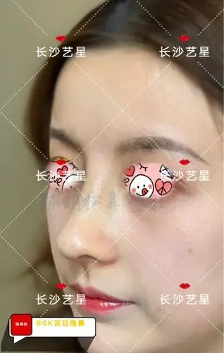 全肋软骨隆鼻,术后12天,局部细节照.