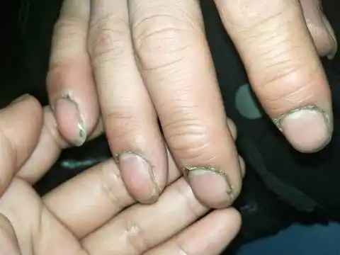 姐妹们,因为上班指甲边的肉裂开很疼,有什么药擦吗?