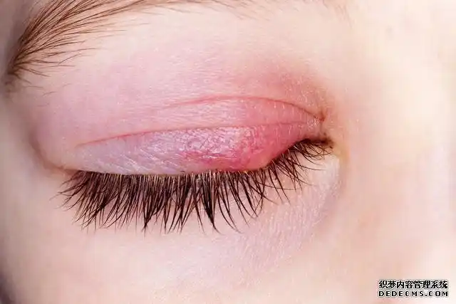 眼睑水肿一定是肾炎引起的吗?