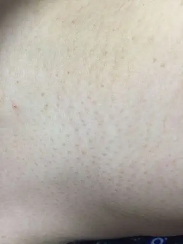 脖子上长了像小米粒一样摸上去一粒粒的小疙瘩,快一年了,到底是长得