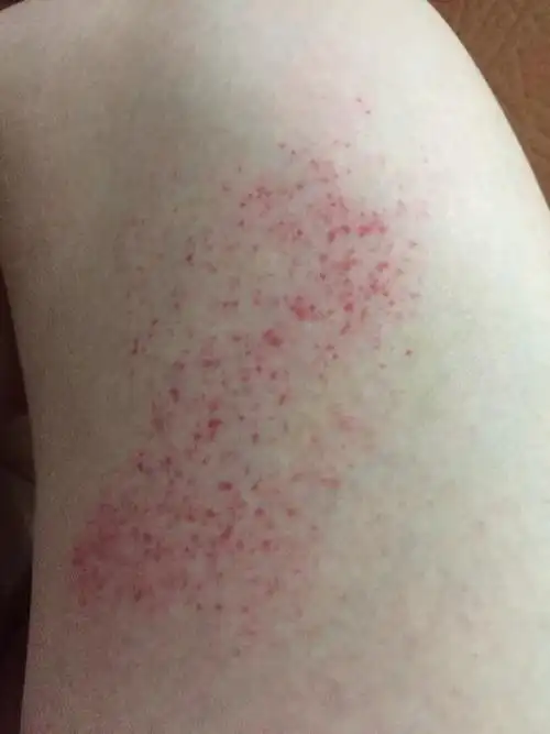 大腿内侧长了这些红点点很痒,请问这是什么?