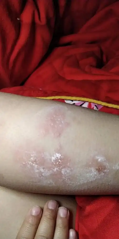 小孩5岁,身上长很多小红块,特别痒,几天之后会起小水泡,吃了赛庚啶片