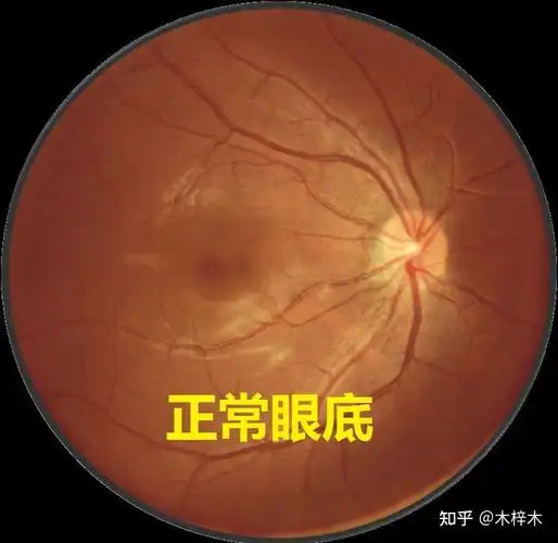首先我们来了解一下正常的眼底是什么样的随着社会发展,近视也越来越