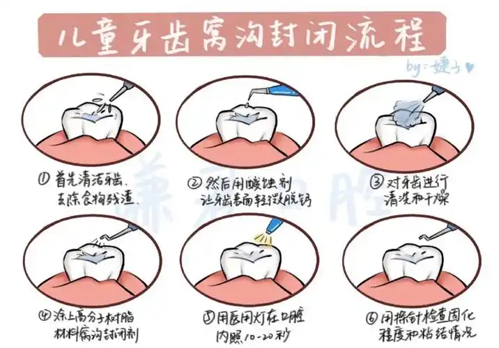 儿童窝沟封闭全过程60宝爸宝妈必看60