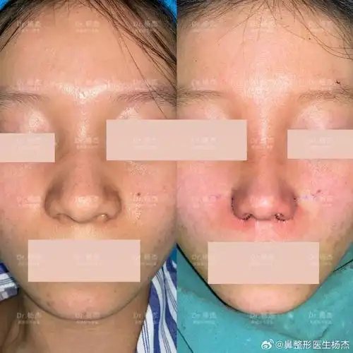 手术采取鼻翼内外联合缩小:1,双侧鼻翼外切改善外扩及鼻翼厚(a段3-4mm
