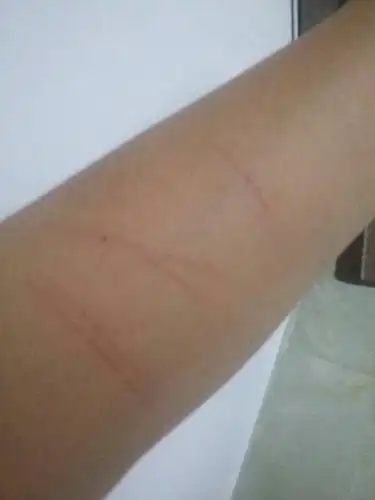 怎么办了今天我和了很多酒,自残了手臂有划了很多刀,明天要开学了这么