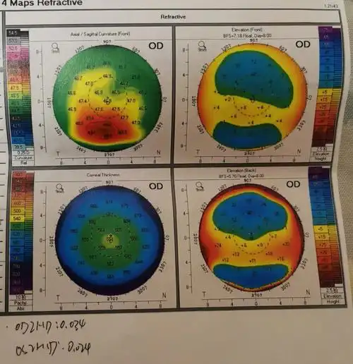 pentacam角膜地形图高度疑似圆锥角膜