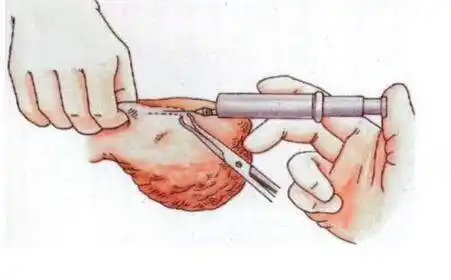 使育龄妇女达到永久性避孕的目的,目前分手术结扎和药物结扎两种方法