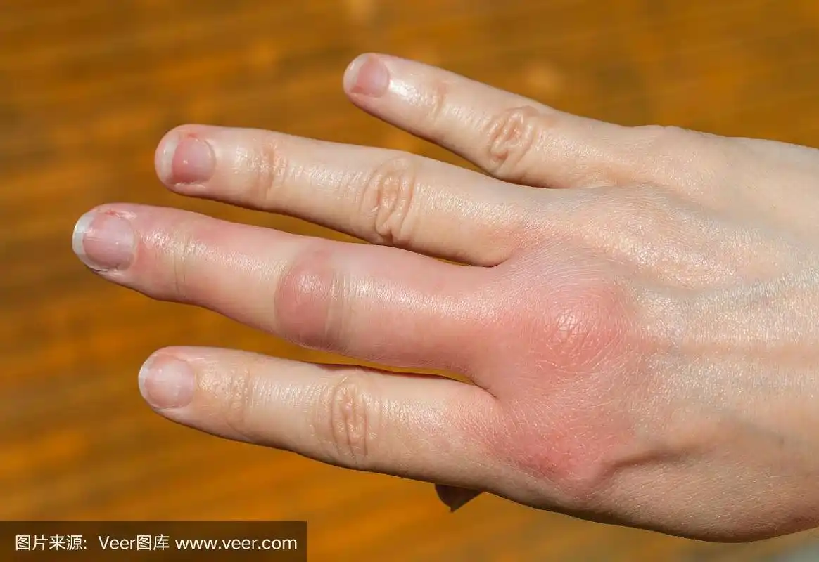 被昆虫咬后肿胀的手