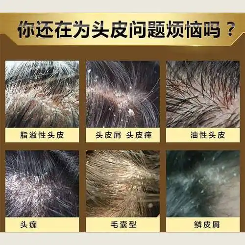 头皮癣头皮屑多用哪个洗发水