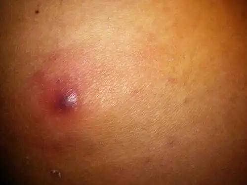 屁股上前两天突然长了个这样的包,摸着很大,里面有点硬,包中间红的带