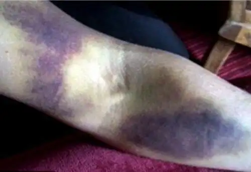 人死后身体为何出现"尸斑"?殡仪馆告诉你真相,看完后长见识了