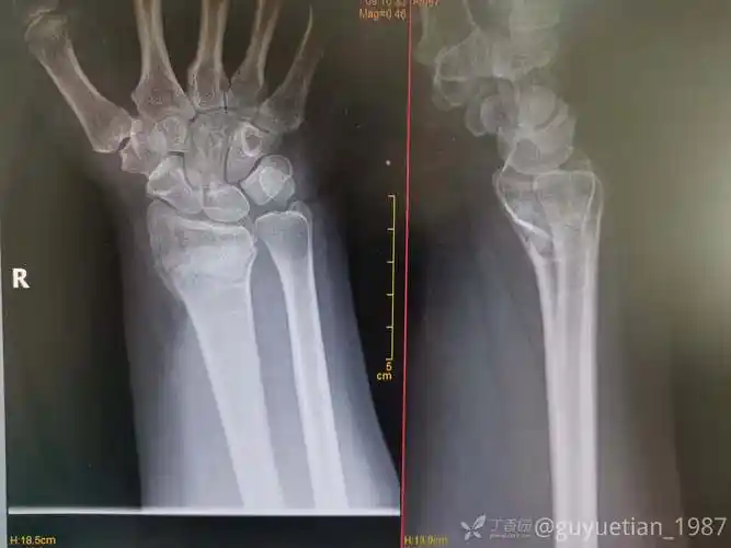 掌侧barton骨折小夹板保守治疗