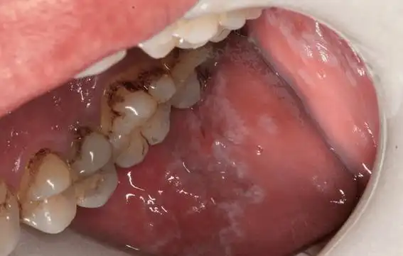 口腔"白斑"≠ 口腔白斑病_黏膜_白色_关键点