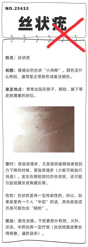 引起的增生性病变,就叫疣,比如扁平疣,寻常疣,丝状疣,跖疣等