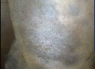 小伙腰部以下发黑以为得重病 医生:裤子掉色